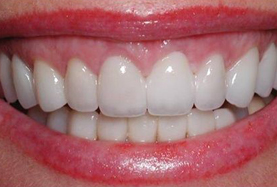 Porselen Diş Tedavisi